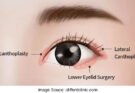 Understanding Epicanthoplasty A Comprehensive Guide To Eyelid Surgery