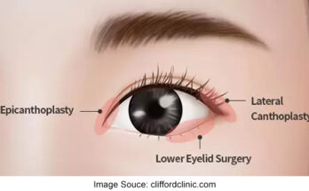 Understanding Epicanthoplasty A Comprehensive Guide To Eyelid Surgery