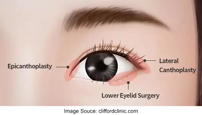 Understanding Epicanthoplasty A Comprehensive Guide To Eyelid Surgery